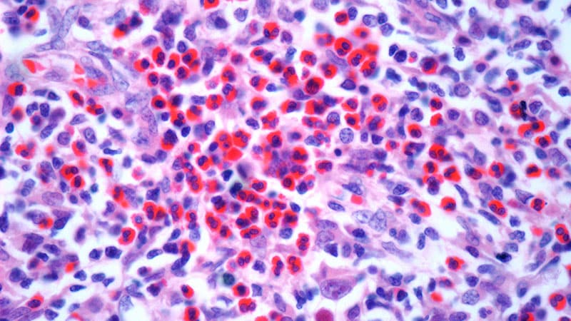 Can New Combo Fill ‘Unmet Need’ in R/R Hodgkin Lymphoma?