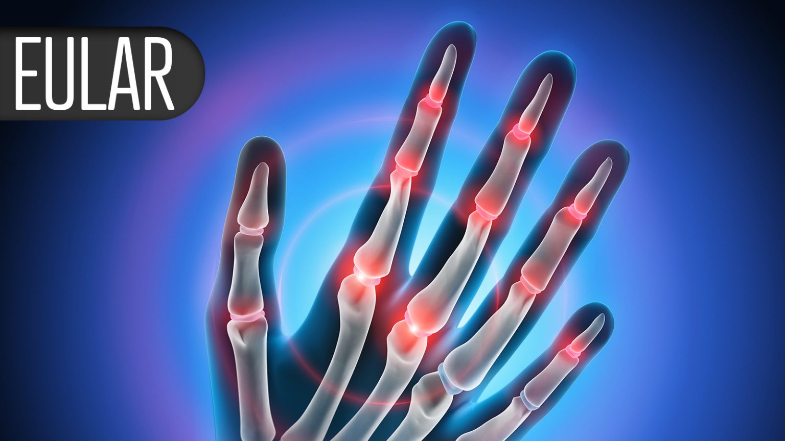 Rheumatology Indication Looks Promising for Efgartigimod