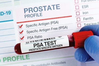 IRONMAN: Can PSA Guide Metastatic Prostate Cancer Care?
