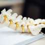 Study reveals risk factors for spinal deterioration in r-axSpA