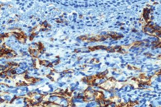 DIF Microscopy Helps Diagnose Pediatric Skin Diseases