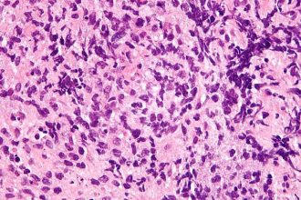 Lymphoma: Dual-Targeting CAR T Shows Safety, Efficacy