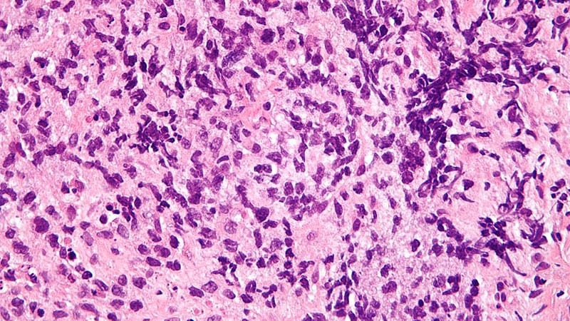 Lymphoma: Dual-Targeting CAR T Shows Safety, Efficacy