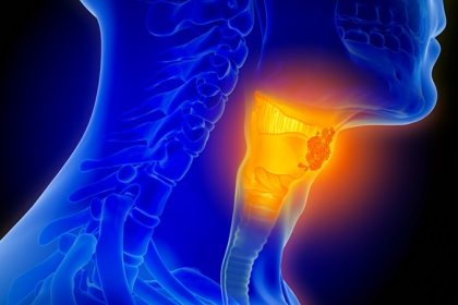 Perioperative Pembro Approved to Up Chance of HNSCC Cure
