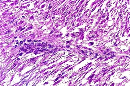 Avelumab Plus Axitinib Shows Promise in Advanced GIST