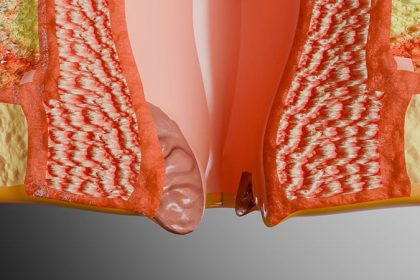 Anal Cancer Screening Benefits HIV-Positive MSM at Age 35