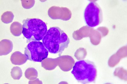 Day in the Life: Clinical Trialist Drives Next-Gen AML Care