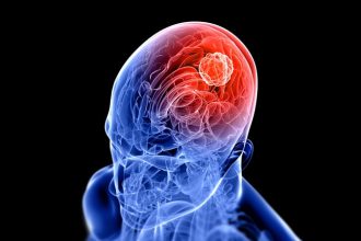 Radiosurgery for GI Cancer Brain Metastases: Does It Help?