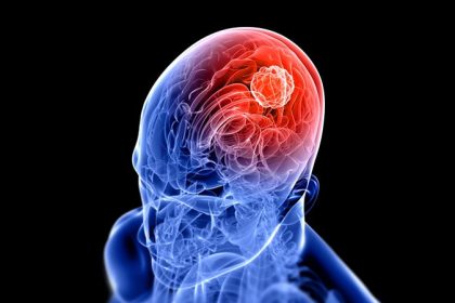 Radiosurgery for GI Cancer Brain Metastases: Does It Help?