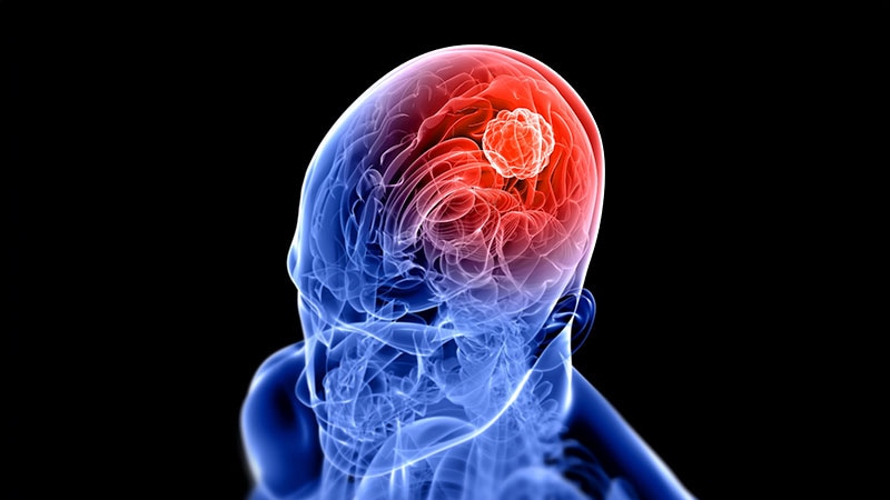 Radiosurgery for GI Cancer Brain Metastases: Does It Help?