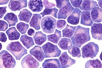 Q&A: New Myeloma Bispecific Rivals CAR T in Early Data