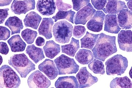 Q&A: New Myeloma Bispecific Rivals CAR T in Early Data