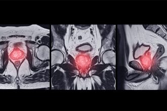 AI Enhances Prostate Cancer Detection in MRI Analysis