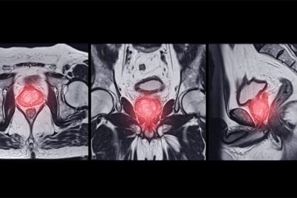 AI Enhances Prostate Cancer Detection in MRI Analysis