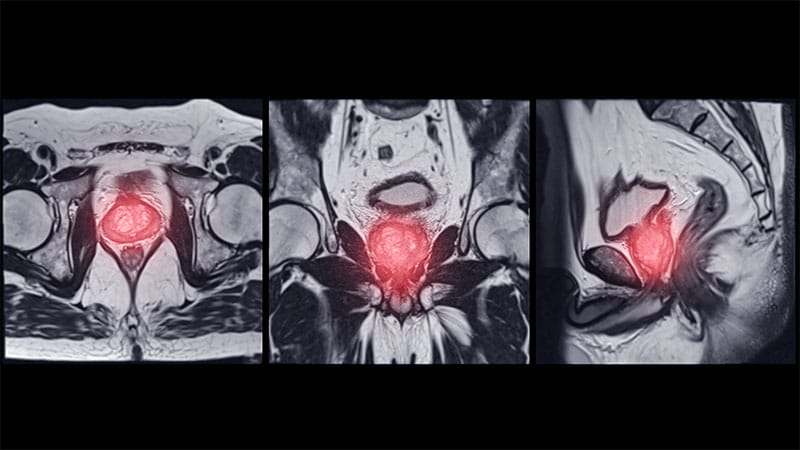 AI Enhances Prostate Cancer Detection in MRI Analysis