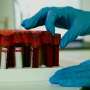 Simple insulin resistance test may also predict cognitive decline in Alzheimer’s patients