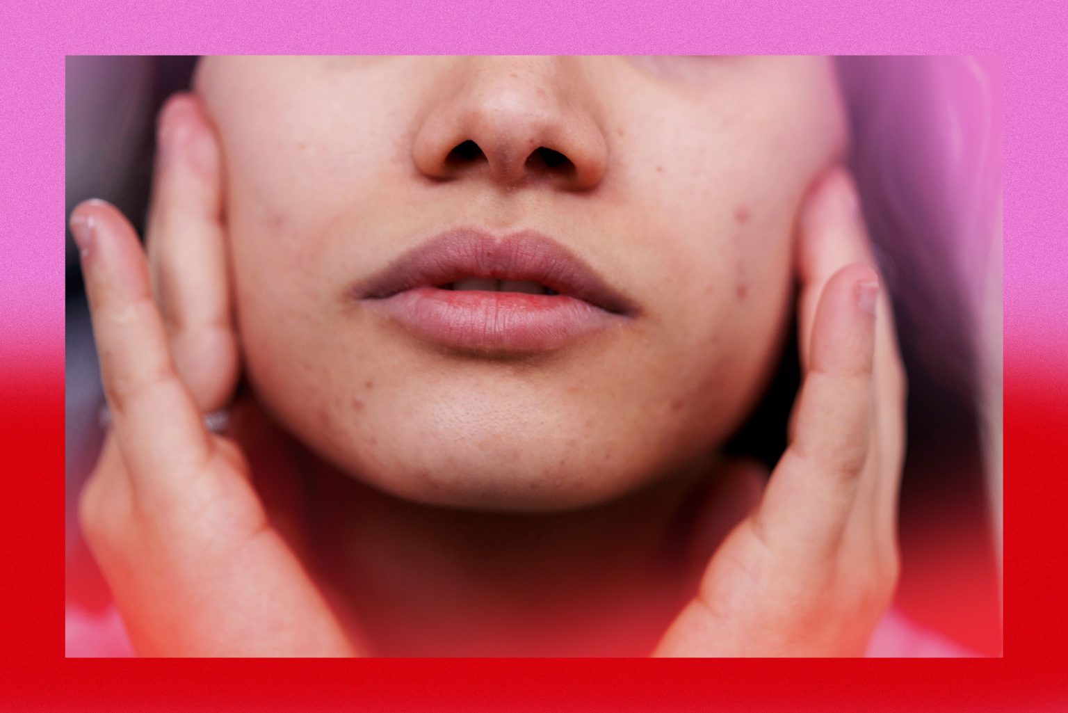 Here’s What PCOS Acne Looks Like—and How to Treat It