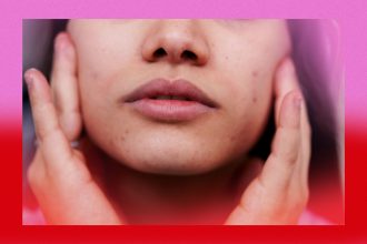 Here’s What PCOS Acne Looks Like—and How to Treat It