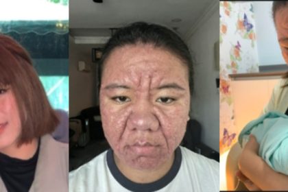 Woman Posts Pictures Of Facial Transformation During Pregnancy
