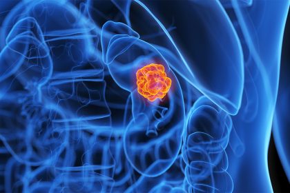 Drug Combo Shows Benefits in Rare, Aggressive Kidney Cancer