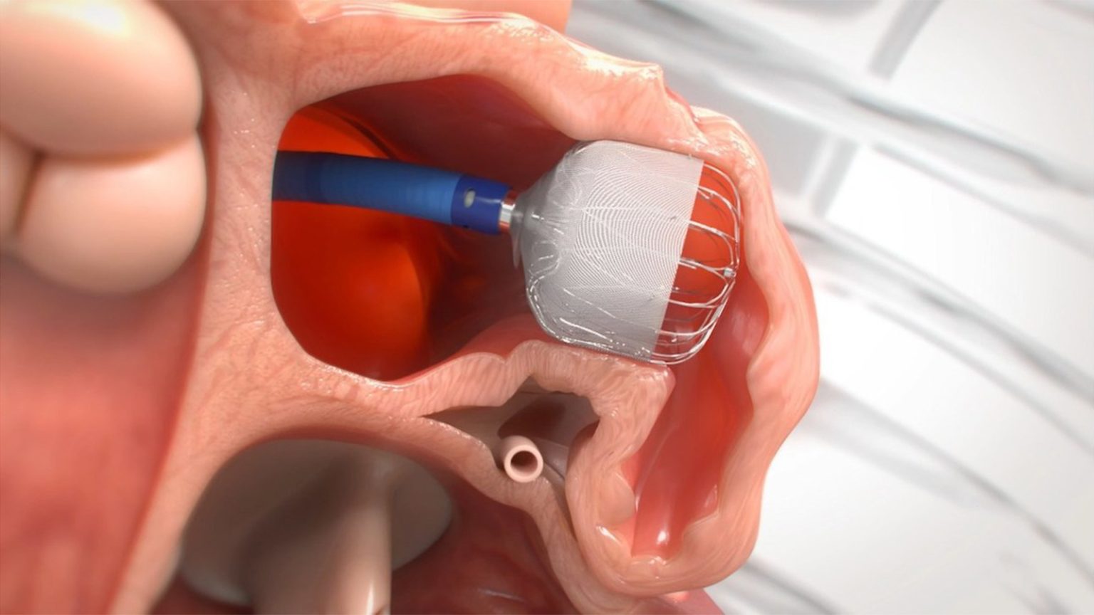 Letting Any Leaky Watchman LAA Implants Slide Linked to Stroke Risk