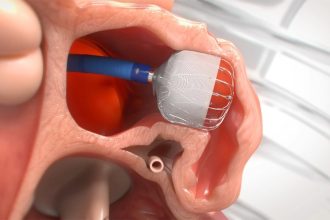 Letting Any Leaky Watchman LAA Implants Slide Linked to Stroke Risk