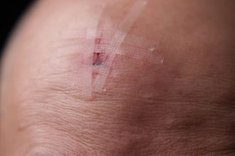 Risk of Malignant Tumor Rises After Traumatic Brain Injury