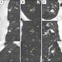 Deep learning model estimates cancer risk of lung nodules