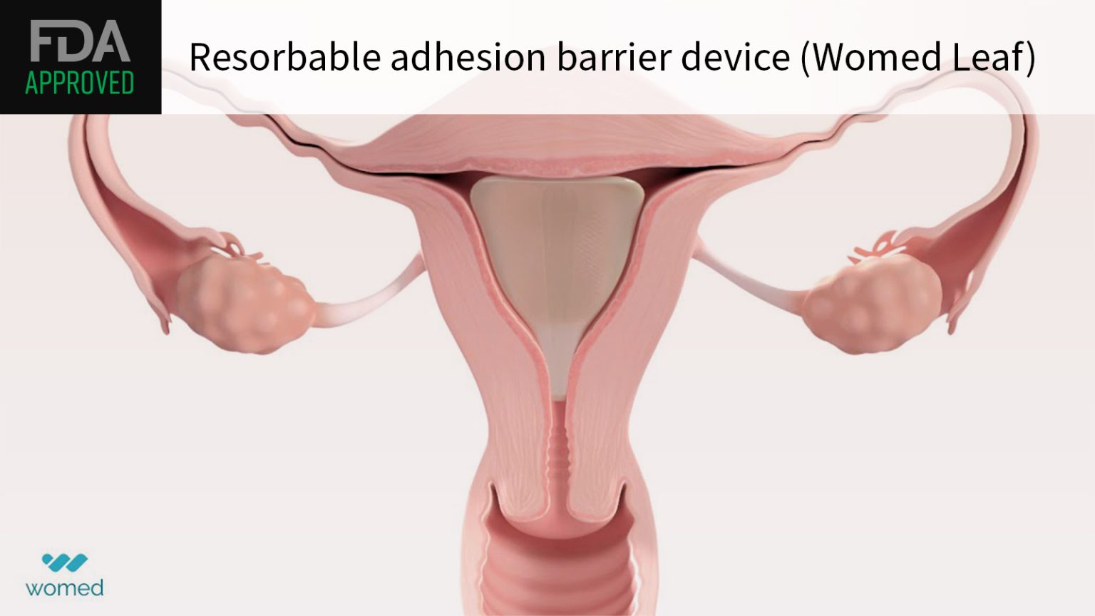 FDA OKs First Device for Intrauterine Adhesions
