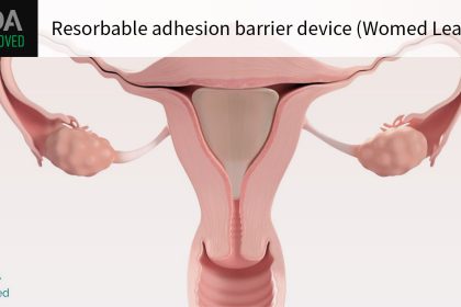 FDA OKs First Device for Intrauterine Adhesions