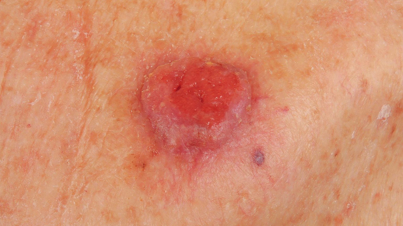 Vitamin B3 Notches a Win for Skin Cancer Prevention