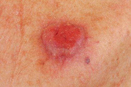 Vitamin B3 Notches a Win for Skin Cancer Prevention