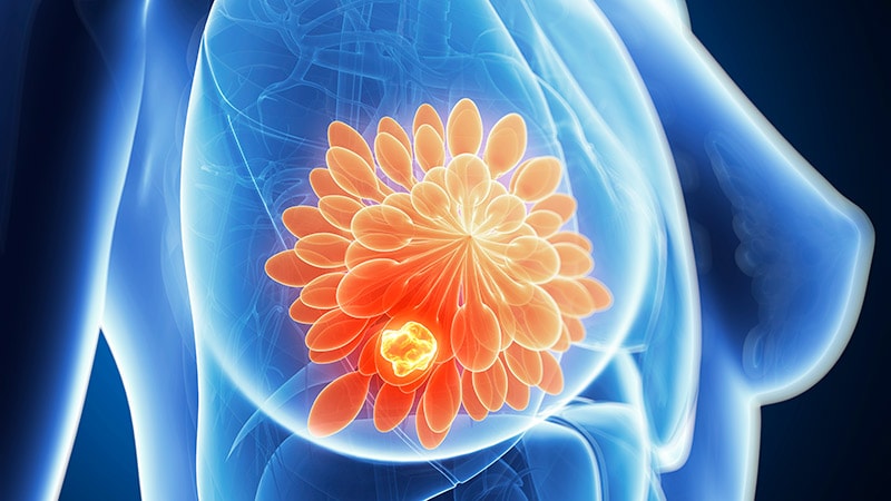 Delayed Breast Cancer Care Raises Mortality Risk