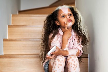 Study: Rx Delayed in Half of US Children With Vitiligo