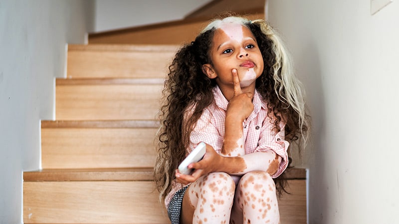 Study: Rx Delayed in Half of US Children With Vitiligo