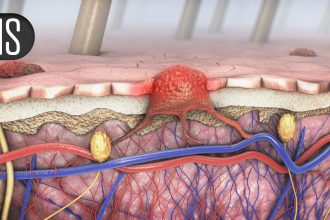 Linvoseltamab Promising in High-Risk Smoldering Multiple Myeloma