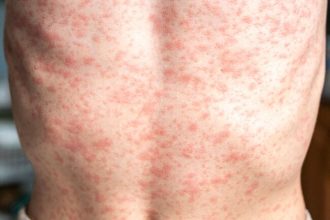 PAHO intensifies call to strengthen vaccination in light of rising measles cases in the Americas