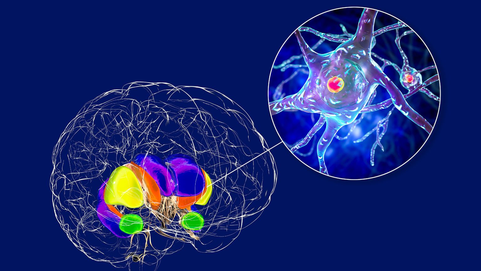 Investigational Gene Therapy Slows Huntington’s Disease Progression