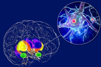 Investigational Gene Therapy Slows Huntington’s Disease Progression