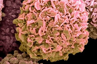 Trends in Global Cancer Cases, Deaths Offer Little Reassurance