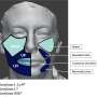 Volumetric study shows objective effects of hyaluronic acid filler injections