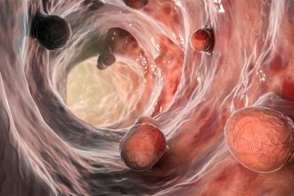 Faecal Biomarker May Reduce Child Colonoscopy Need