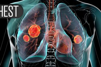 Adverse Event Risks Vary Among Asthma Biologics, FDA Data Show
