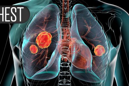 Adverse Event Risks Vary Among Asthma Biologics, FDA Data Show