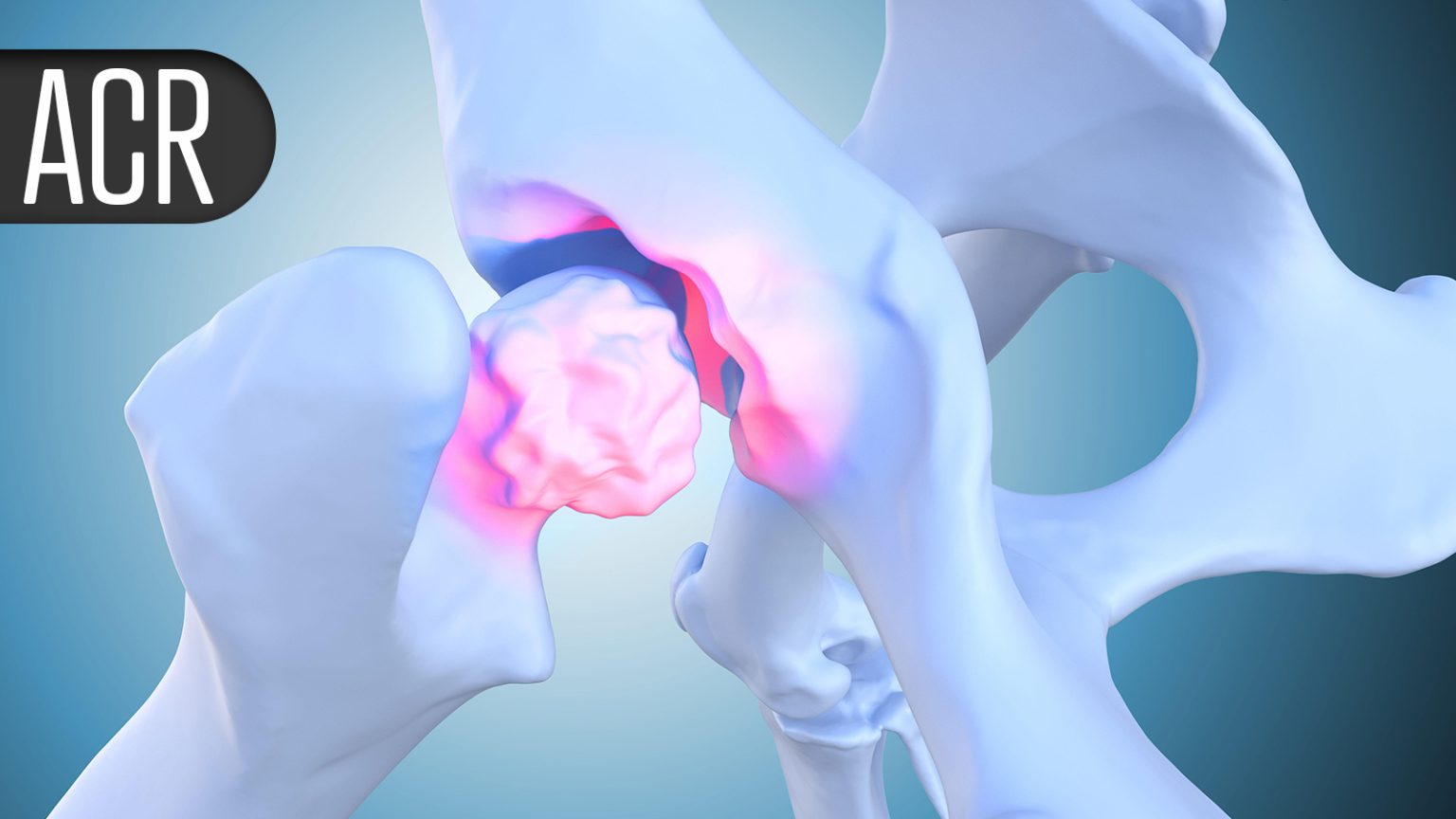 JAK Inhibitor Stays Effective Beyond 1 Year for Giant Cell Arteritis