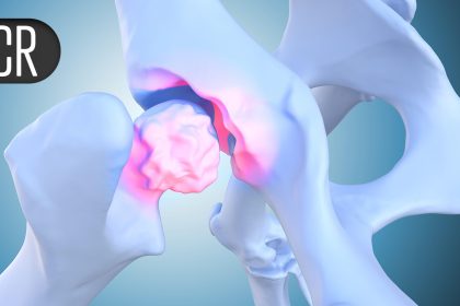 JAK Inhibitor Stays Effective Beyond 1 Year for Giant Cell Arteritis