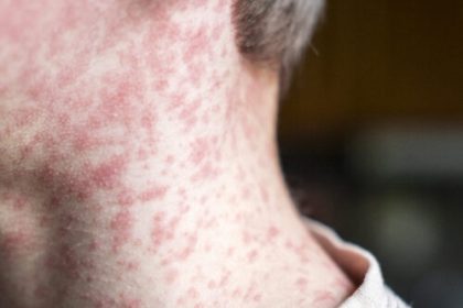 Measles outbreak investigation in Utah blocked by patient who refuses to talk