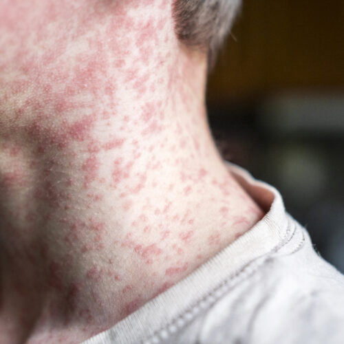 Measles outbreak investigation in Utah blocked by patient who refuses to talk