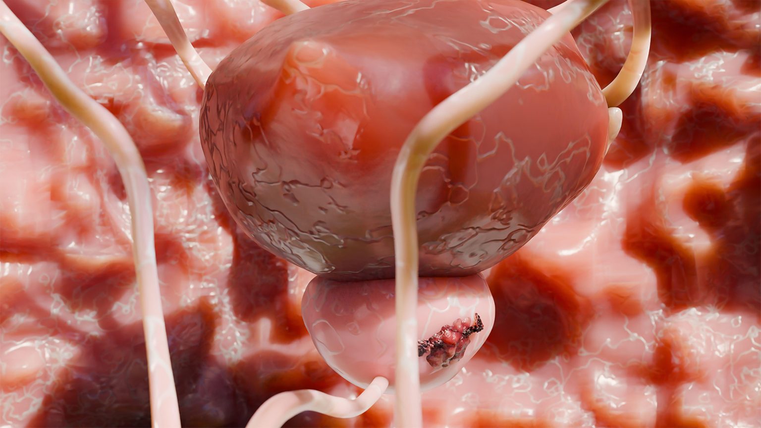 PSA Screening Reduces Prostate Cancer Deaths, Long-Term Data Show