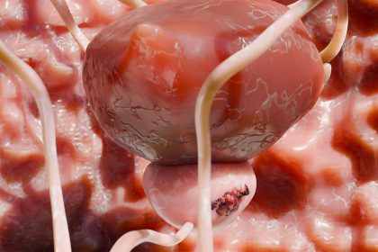 PSA Screening Reduces Prostate Cancer Deaths, Long-Term Data Show